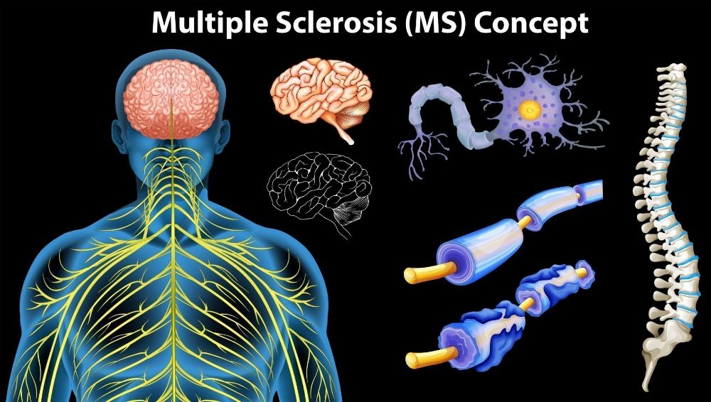 مولتیپل اسکلروزیس (MS)